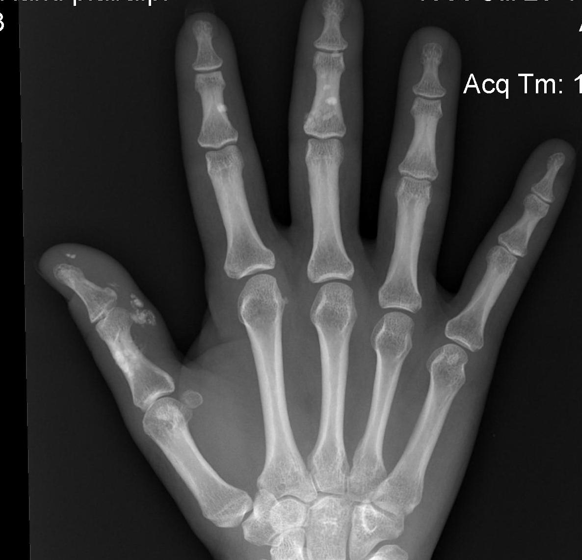 Hand Scleroderma